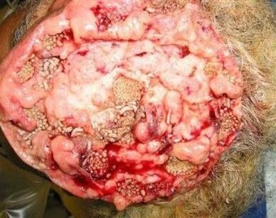 parazīti cilvēka smadzenēs